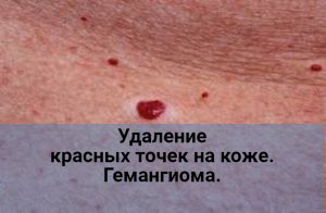 Удаление красных точек на коже. Гемангиома.