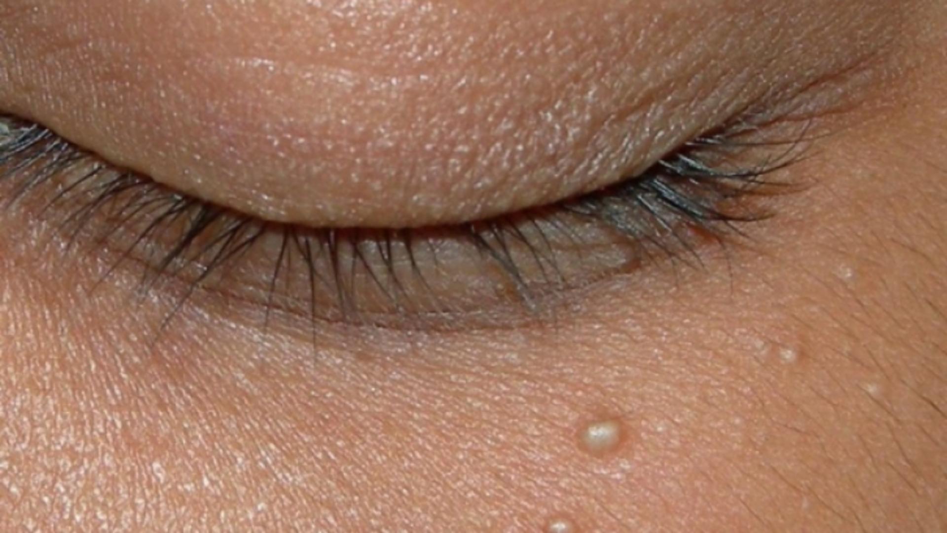 Прощай просянка! Простые способы избавления.