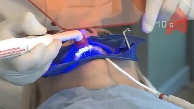 Виниры: коррекция формы и цвета зубов смотреть онлайн