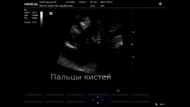 Первый скрининг при ХА смотреть онлайн