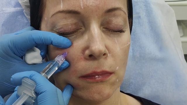 HYALUFORM Deep booster - Процедура «Гидролифтинг» смотреть онлайн