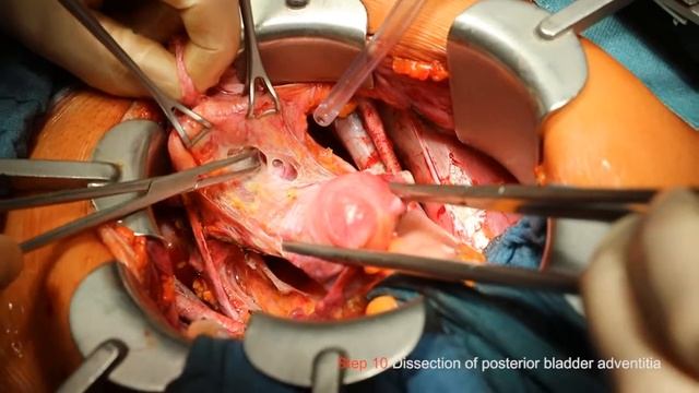 Total mesometrial resection and therapeutic pelvic lymph node dissection: step-by-step: 3 смотреть онлайн