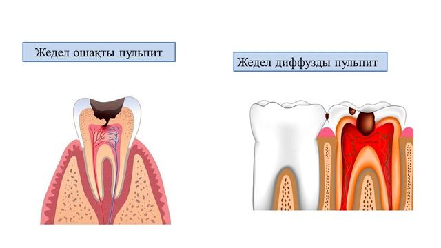 Жедел ұлпа қабынуы Пульпит