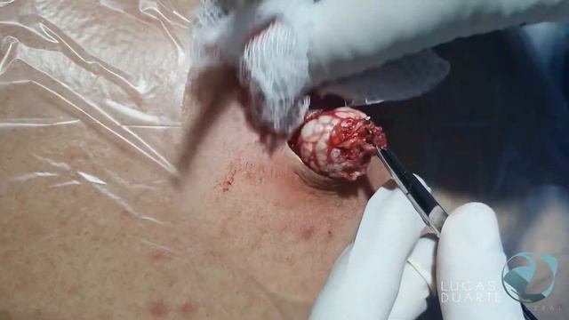 [10NOV21] DR. LUCAS DUARTE • Sebaceous Cyst- Cisto Sebáceo смотреть онлайн
