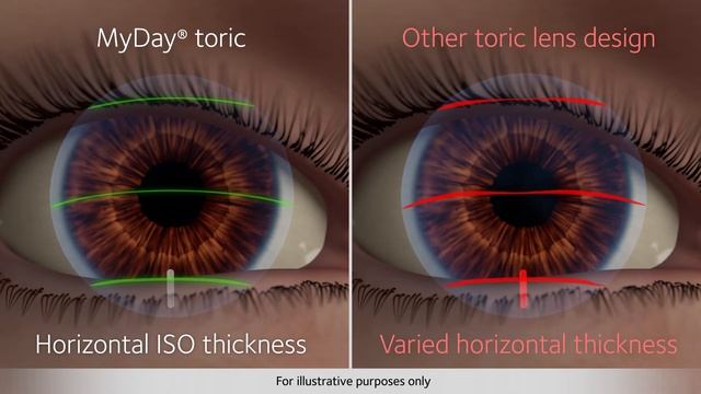 Upgrade your Astigmatic Patients to MyDay® toric смотреть онлайн