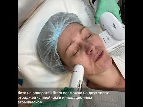 SMAS-lifting в Орле на аппарате Liftera смотреть онлайн