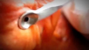 Big Blackhead in the ear. Большой прыщ в ухе., 疙瘩, にきび, ニキビ