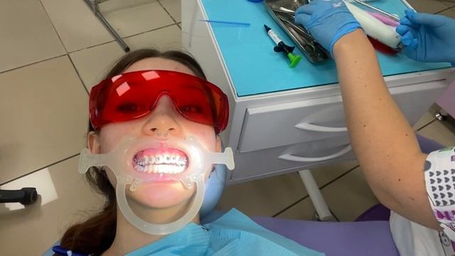 Поставила БРЕКЕТЫ/ Влог/ Моя история/Эмоции;) смотреть онлайн