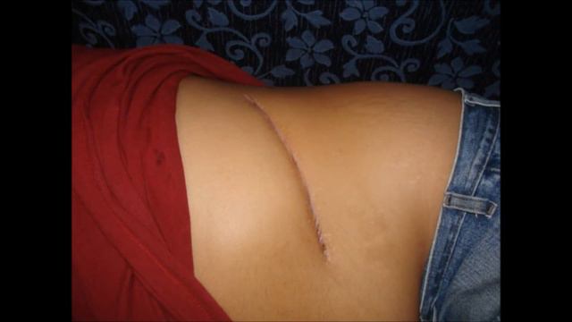 Nefroctomia Radical.wmv смотреть онлайн