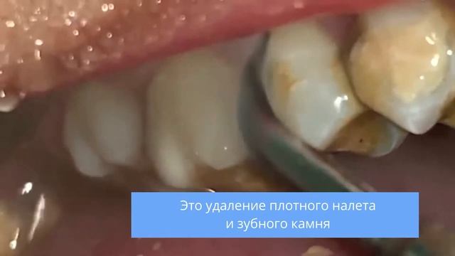 Чистка зубов ультразвуком смотреть онлайн