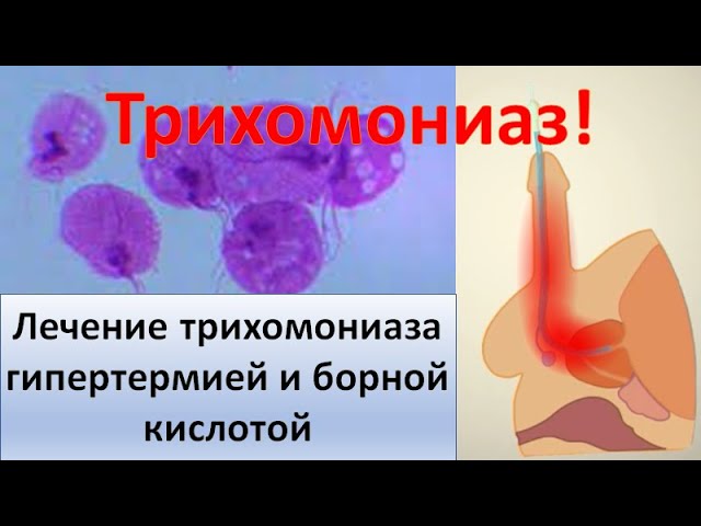 Лечение хронического трихомониаза гипертермией и борной кислотой смотреть онлайн