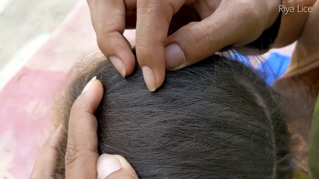 Getting Out All Most Of Lice From Brown Hair - How To Remove Lice From Her Head