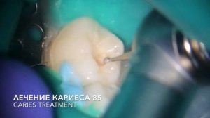 пульпит  молочного зуба