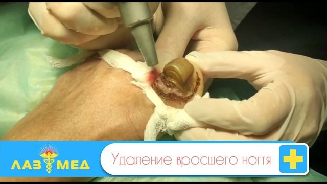 Удаление вросшего ногтя смотреть онлайн