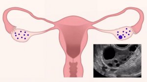 Овуляция и жёлтое тело в яичнике