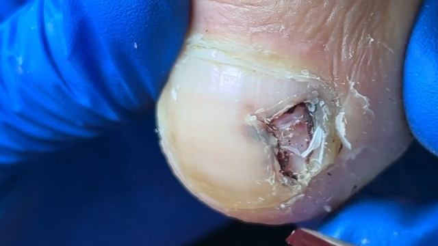 There is blood on the inside of the toenail! Gentle Trim【Xue Yidao】 смотреть онлайн