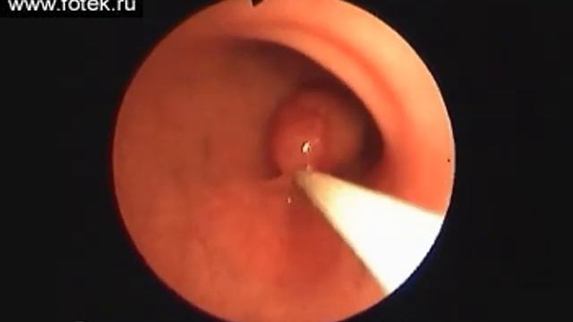 Эндоскопическая полипэктомия толстого кишечника смотреть онлайн