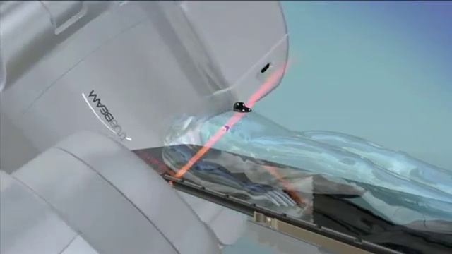 Лучевая терапия Rapid Arc смотреть онлайн