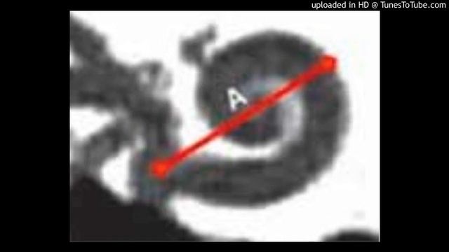 Cochlear duct length - Dr. Mohnish Grover смотреть онлайн