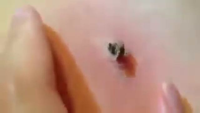 вскрытие застаревшего гнойка смотреть онлайн