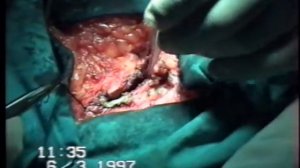 Ущемлённая пупочная грыжа