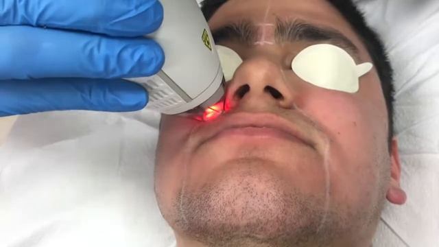 Clear + Brilliant 1440 Nm Laser Treatment By Dr. Patel In Miami, FL