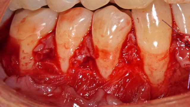 Хирургическое лечение рецессии десны 3.3 смотреть онлайн