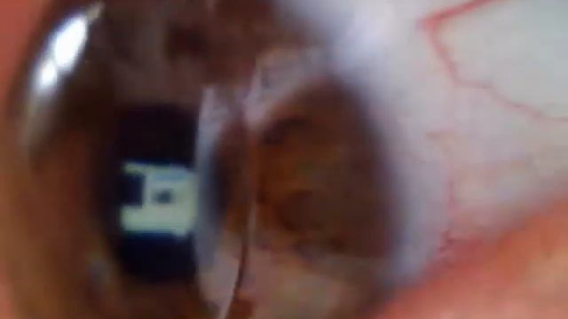 Кератоконус с жесткими линзами 1 (Дистрофия роговицы глаза) смотреть онлайн