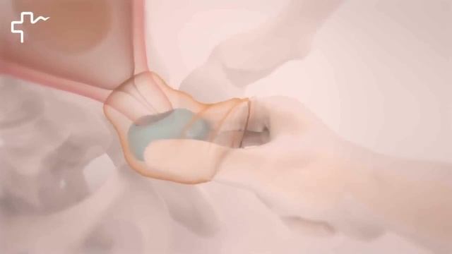 Введение акушерского пессария Арабин