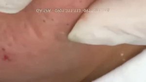 ДАВИМ АКНЕ ЧЕРНЫЕ ТОЧКИ