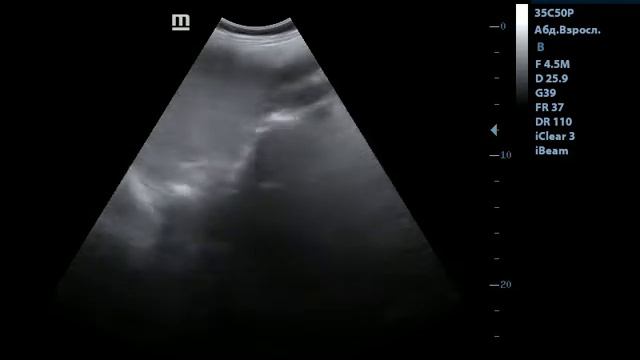 Splenomegaly Ultrasound. Спленомегалия на УЗИ смотреть онлайн