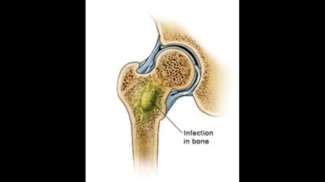 Как лечить и вылечить позвоночного остеомиелита смотреть онлайн