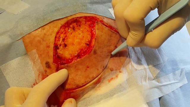 Keystone Flap Repair Following Melanoma Excision. #74