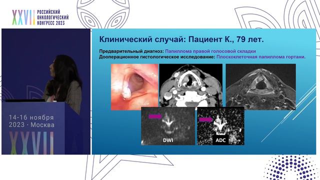 Лучевая диагностика при раке гортани. Возможности и перспективы смотреть онлайн