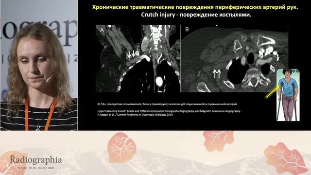 КТ-ангиография сосудов верхних и нижних конечностей. Доклад на слете Radiographia 2021 смотреть онлайн