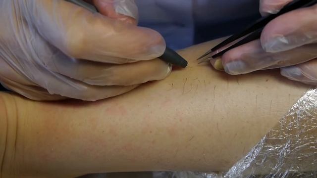 Электроэпиляция в Пироговском смотреть онлайн