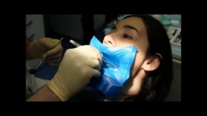 Пломбирование полости класса I композитным материалом ДентЛайт