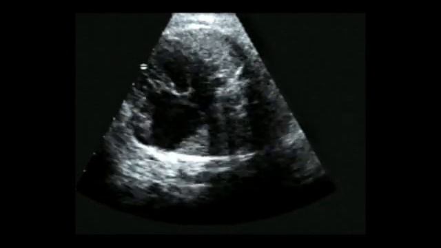 4. Аномалия Эбштейна у плода (Ebstein's anomaly in fetus) смотреть онлайн