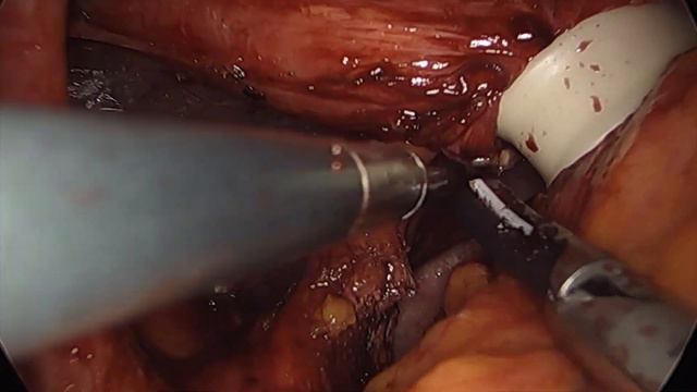 Hiatal Hernia Repair With Actual Surgical Footage & Animation