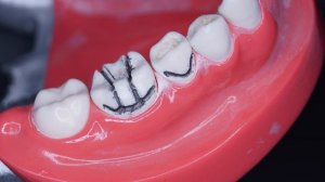 Коронка из диоксида циркония, её преимущества над металлокерамикой. Особенности препарирования.