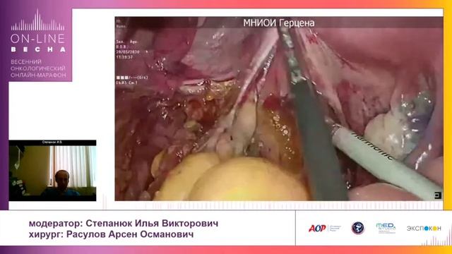 LIVE Lap partial ME, BMI 35. Онлайн лап резекция прямой кишки. МНИОИ П.А.Герцена 29.05.20 смотреть онлайн