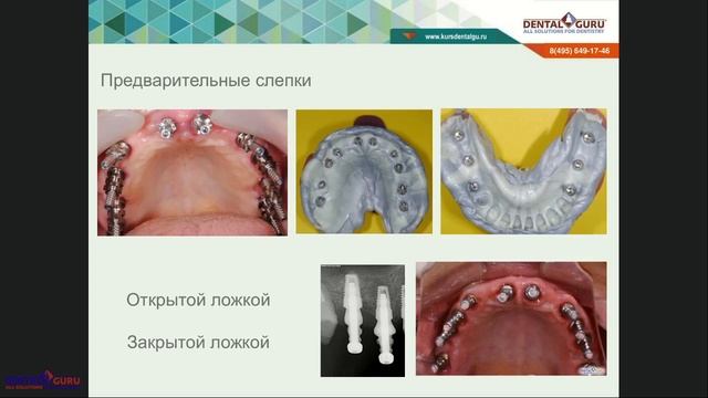 2018 05 29 ХАБИЕВ К Снятие слепков с имплантатов Особенности, нюансы, лайфхаки смотреть онлайн