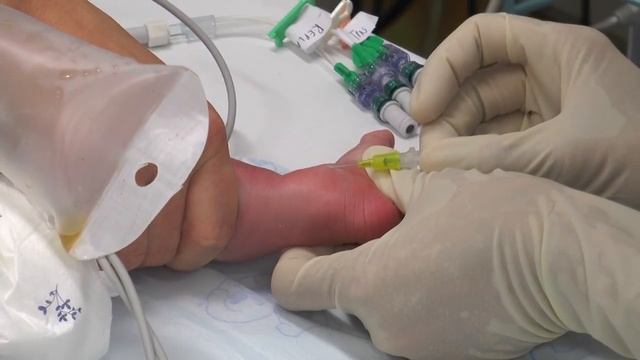 Paediatric Anaesthetics: Chapter 7 - Long saphenous IV neonate 1 смотреть онлайн