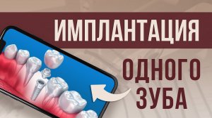 ИМПЛАНТАЦИЯ ОДНОГО ЗУБА. Современный метод ВОССТАНОВЛЕНИЯ ЗУБНОГО РЯДА.
