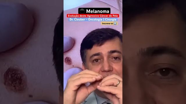 ⚫️ Melanoma: Saiba porque a Regressão é tão Perigosa. #shorts смотреть онлайн