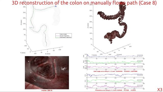 3D Reconstruction of Colon Structures and Textures from Stereo Colonoscopic Images смотреть онлайн