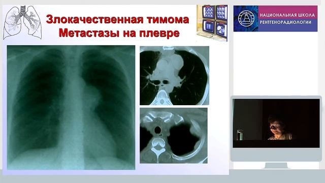 Опухоли и кисты средостения смотреть онлайн