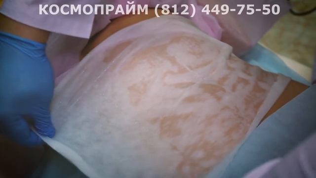 Криолиполиз SL4 липосакция холодом смотреть онлайн