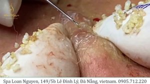 Relax with good videos on getting rid of acne (205) | Loan Nguyen
