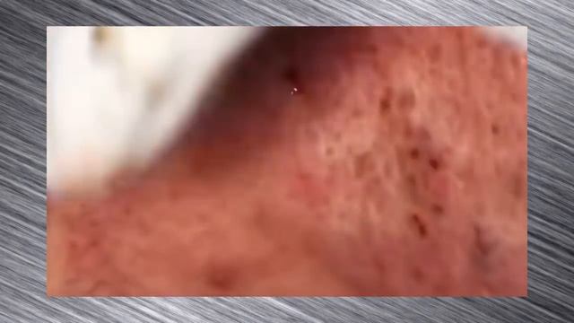 УГРИ ПРЫЩИ! ДАВИМ ОГРОМНЫЕ ЧЕРНЫЕ ТОЧКИ  ЧИСТКА ЛИЦА